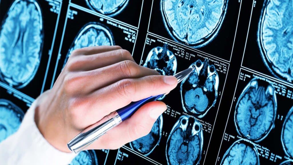 A hand holding a pen points at a series of brain scan images, likely MRI or CT scans, displayed on a screen or film. The scans show cross-sectional views of the human brain.