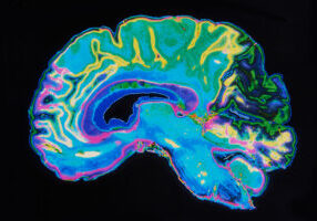 MRI Brain Scan depicting dimentia in patient at senior community