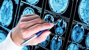A hand holding a pen points at a series of brain scan images, likely MRI or CT scans, displayed on a screen or film. The scans show cross-sectional views of the human brain.