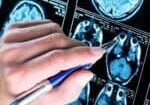 Alzheimers disease A hand holding a pen points at a series of brain scan images, likely MRI or CT scans, displayed on a screen or film. The scans show cross-sectional views of the human brain.