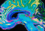 MRI Brain Scan depicting dimentia in patient at senior community